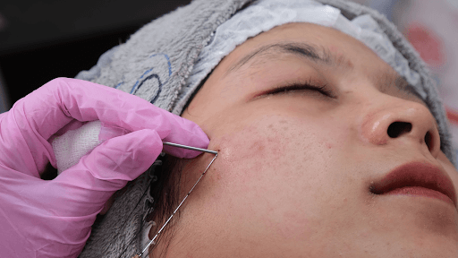 Vampire Facial Florida